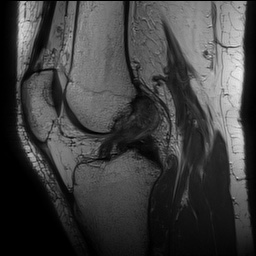 Anterior cruciate ligament rupture with Segond fracture (Radiopaedia 69043-78806 Sagittal PD 101).jpg