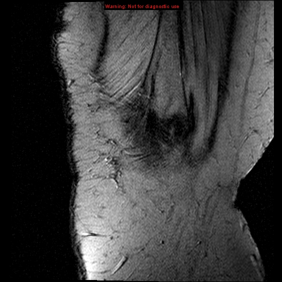 File:Anterior cruciate ligament tear (Radiopaedia 12329-12612 A 21).jpg