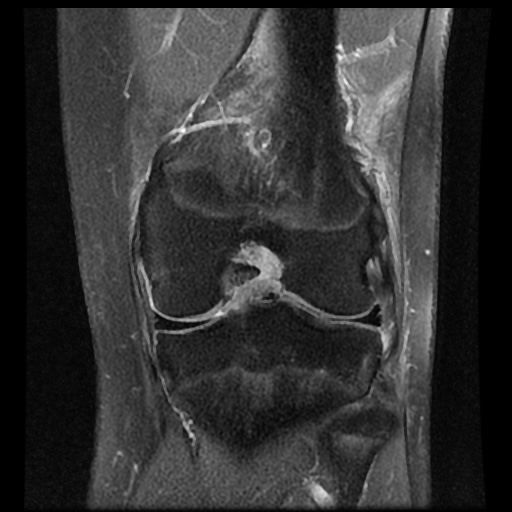 File:Anterior cruciate ligament tear (Radiopaedia 61500-69462 Coronal PD fat sat 13).jpg