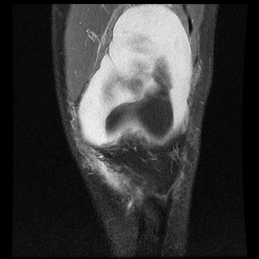 File:Anterior cruciate ligament tear (Radiopaedia 61500-69462 Coronal PD fat sat 5).jpg