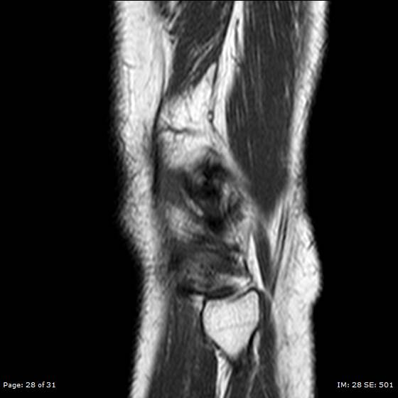 File:Anterior cruciate ligament tear (Radiopaedia 70783-80964 Sagittal T1 28).jpg