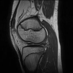 File:Anterior cruciate ligament tear - pediatric (Radiopaedia 62152-70260 Sagittal PD 125).jpg