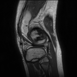 Anterior cruciate ligament tear - pediatric (Radiopaedia 62152-70260 Sagittal PD 144).jpg
