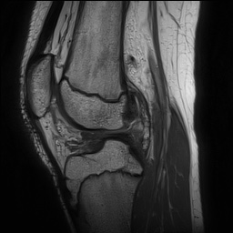 Anterior cruciate ligament tear - pediatric (Radiopaedia 62152-70260 Sagittal PD 99).jpg