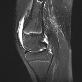 File:Anterior cruciate ligament tear - pediatric (Radiopaedia 62152-70260 Sagittal PD fat sat 15).jpg