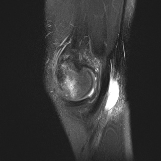 File:Anterior cruciate ligament tear - pediatric (Radiopaedia 62152-70260 Sagittal PD fat sat 8).jpg