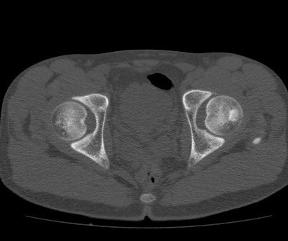 Anterior inferior iliac spine avulsion fracture (Radiopaedia 81312-94999 Axial bone window 54).jpg