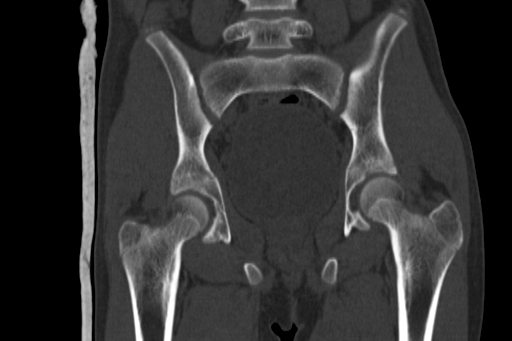 Anterior inferior iliac spine avulsion injury (Radiopaedia 88666-105376 Coronal bone window 41).jpg