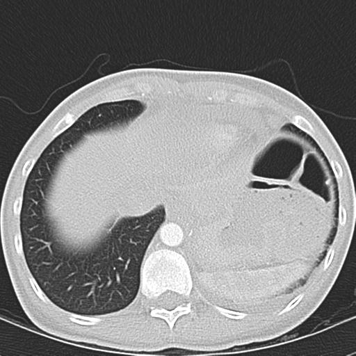 Anterior mediastinal lymphoma (Radiopaedia 29556-30061 Axial lung window 47).jpg