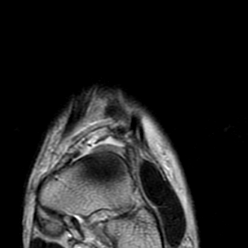 File:Anterior talofibular ligament rupture (Radiopaedia 15831-15484 Coronal T2 1).jpg