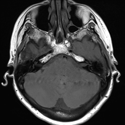 File:Anterior temporal encephalocele (Radiopaedia 82624-96808 Axial T1 8).jpg