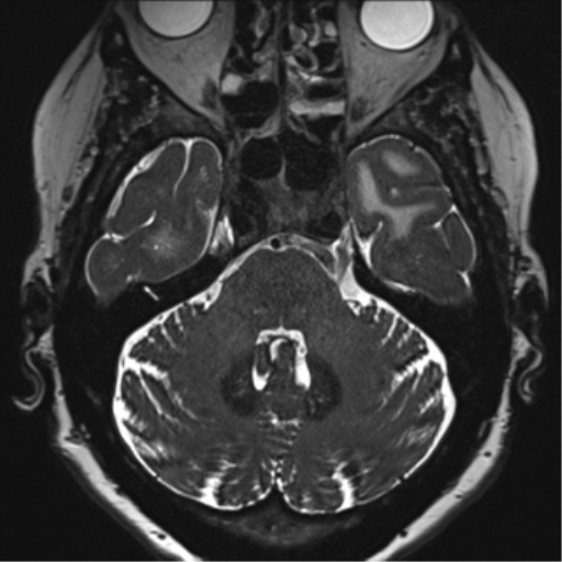 Anterior temporal pole cysts (Radiopaedia 46629-51102 Axial T2 43).png