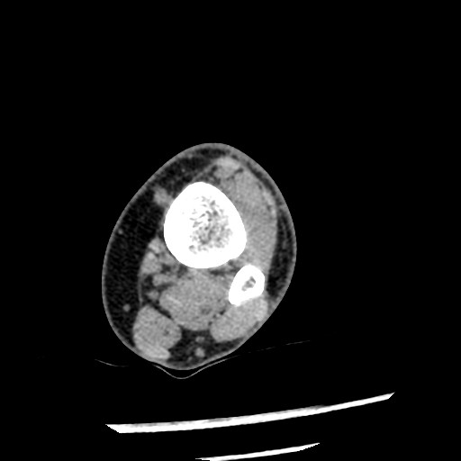 File:Anterior tibial artery false aneurysm (Radiopaedia 88984-105809 A 65).jpg