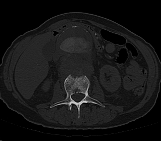 File:Anterior vertebral scalloping (abdominal aortic aneurysm) (Radiopaedia 66744-76067 Axial bone window 4).jpg