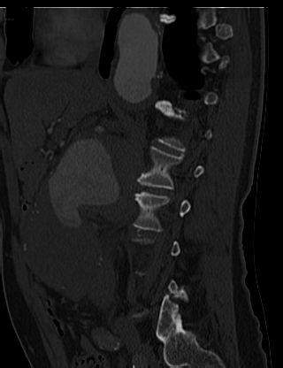 File:Anterior vertebral scalloping (abdominal aortic aneurysm) (Radiopaedia 66744-76067 Sagittal bone window 9).jpg