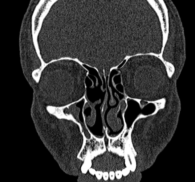 File:Antrochoanal polyp (Radiopaedia 30002-30554 Coronal bone window 28).jpg