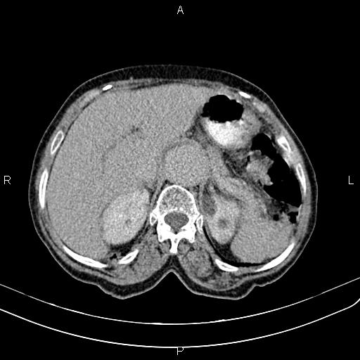Aortic aneurysm and Lemmel syndrome (Radiopaedia 86499-102554 Axial C+ delayed 21).jpg