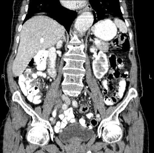 Aortic aneurysm and Lemmel syndrome (Radiopaedia 86499-102554 C 33).jpg