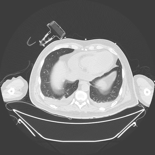 Aortic arch aneurysm (Radiopaedia 84109-99365 Axial lung window 216).jpg