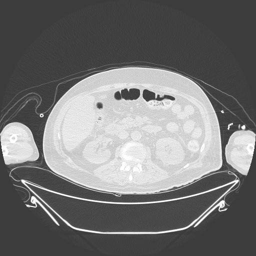 Aortic arch aneurysm (Radiopaedia 84109-99365 Axial lung window 344).jpg