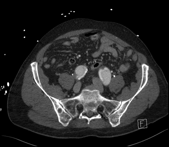 Aortic dissection (CTPA) (Radiopaedia 75506-86750 E 110).jpg