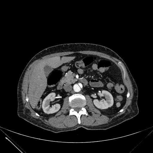 Aortic dissection (Radiopaedia 27466-27665 C+ arterial phase 352).jpg
