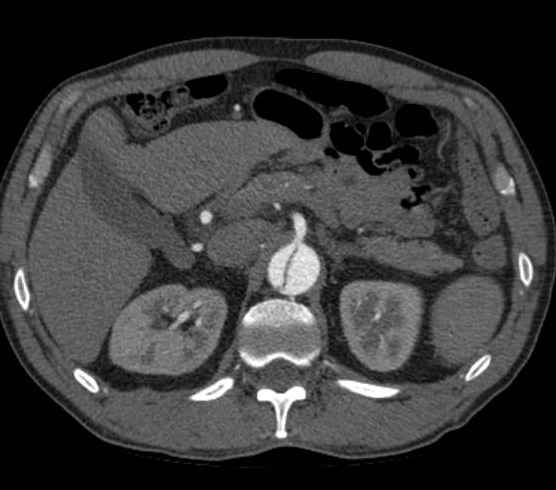 File:Aortic dissection - Stanford type B (Radiopaedia 73648-84437 A 131).jpg