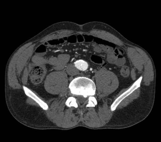 Aortic dissection - Stanford type B (Radiopaedia 73648-84437 A 194).jpg