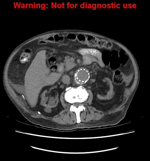 File:Aortic graft infection (Radiopaedia 44979-48907 Axial non-contrast 44).jpg