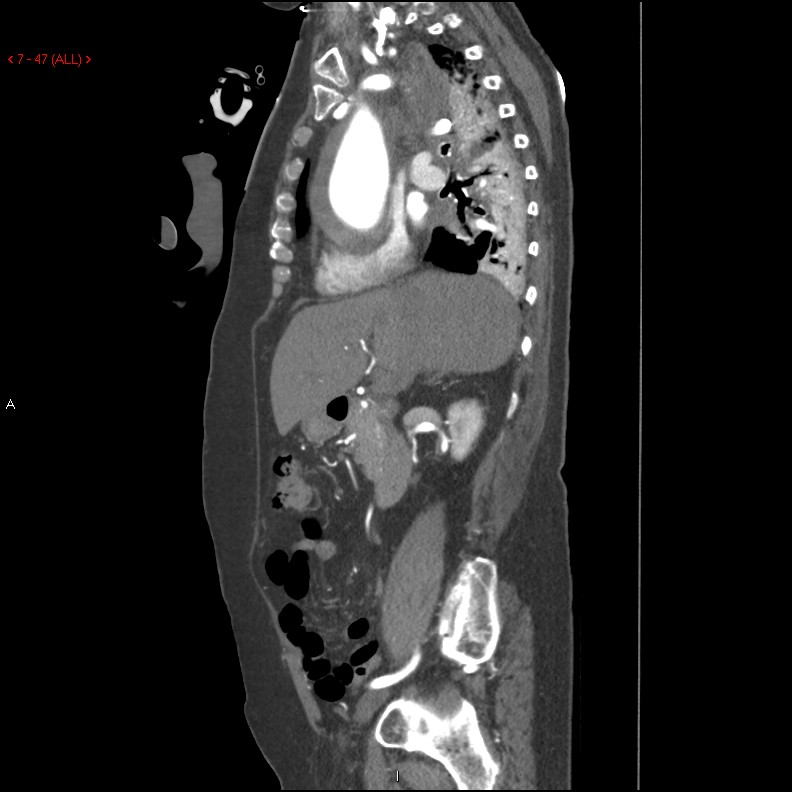 Aortic intramural hematoma (Radiopaedia 27746-28001 C 16).jpg