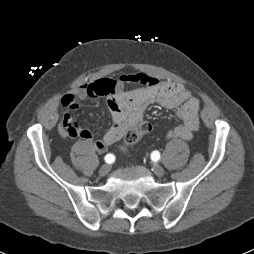 File:Aortic intramural hematoma (Radiopaedia 31139-31838 B 137).jpg
