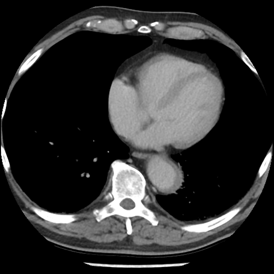 Aortic intramural hematoma (type B) (Radiopaedia 79323-92387 Axial C+ delayed 37).jpg