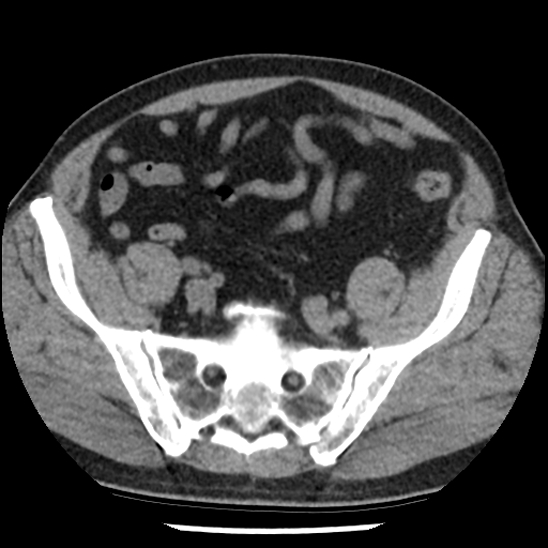 Aortic intramural hematoma (type B) (Radiopaedia 79323-92387 Axial non-contrast 95).jpg