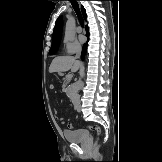 Aortic intramural hematoma (type B) (Radiopaedia 79323-92387 G 23).jpg