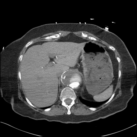 Aortic intramural hematoma with dissection and intramural blood pool (Radiopaedia 77373-89491 B 100).jpg