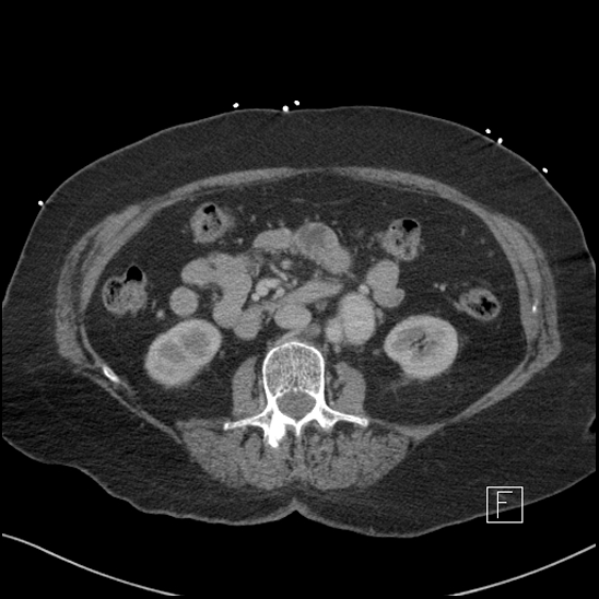 Aortic intramural hematoma with dissection and intramural blood pool (Radiopaedia 77373-89491 E 36).jpg
