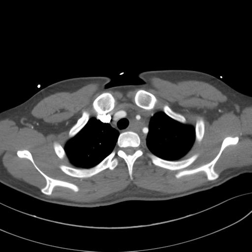 File:Aortic transection (Radiopaedia 29890-30405 A 22).jpg