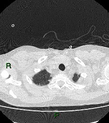 File:Aortic valve endocarditis (Radiopaedia 87209-103485 Axial lung window 15).jpg