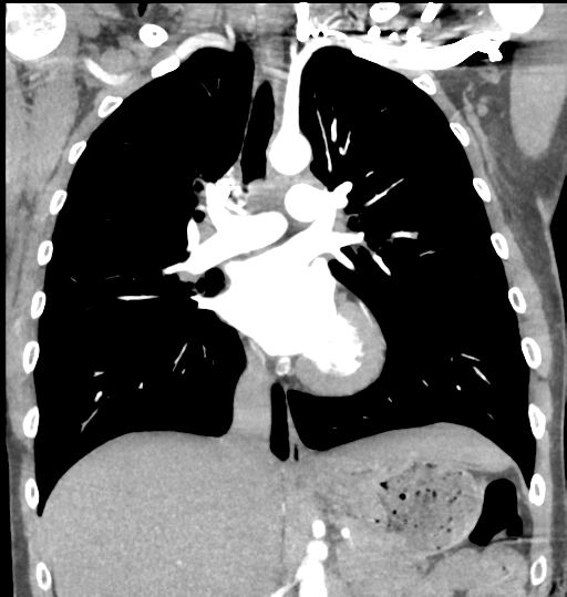 Aortic valve non-coronary cusp thrombus (Radiopaedia 55661-62189 C 40).png