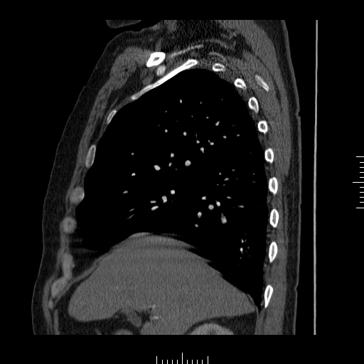 File:Aorto-coronary bypass graft aneurysms (Radiopaedia 40562-43157 C 3).png