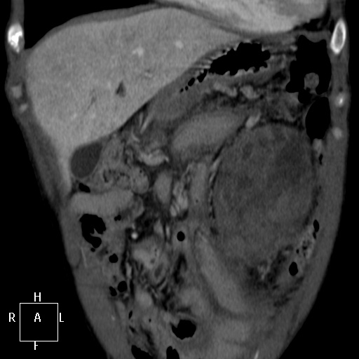 Aorto-left renal vein fistula (Radiopaedia 45534-49628 B 3).jpg