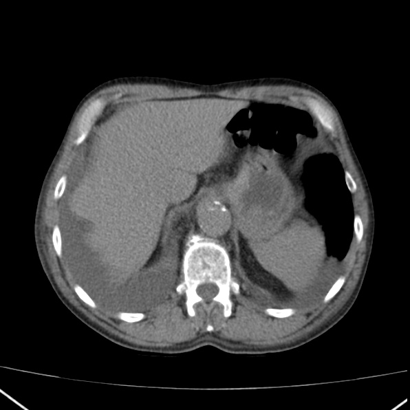 Aortoiliac occlusive disease (Radiopaedia 32134-33076 Axial non-contrast 9).jpg
