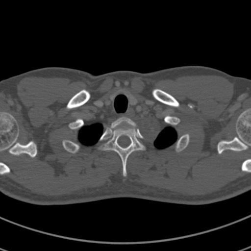 Apical lung mass mimic - neurogenic tumor (Radiopaedia 59918-67521 Axial bone window 6).jpg
