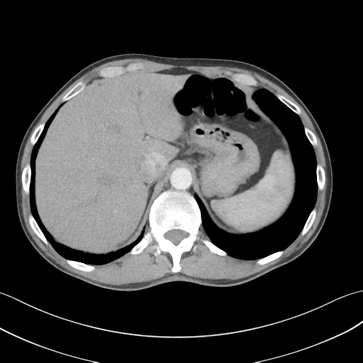 File:Apical pleural calcification (Radiopaedia 46141-50499 Axial C+ delayed 65).png