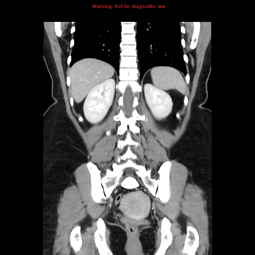 Appendiceal mucinous cystadenoma (Radiopaedia 8263-9111 B 55).jpg