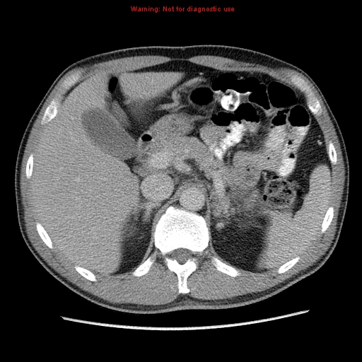 Appendicitis and renal cell carcinoma (Radiopaedia 17063-16760 A 15).jpg