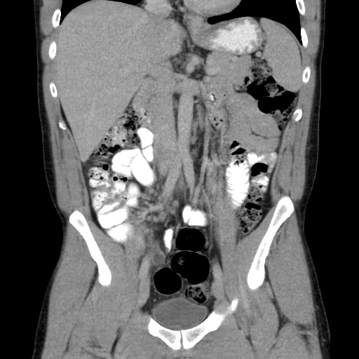 Appendicitis complicated by post-operative collection (Radiopaedia 35595-37113 B 26).jpg