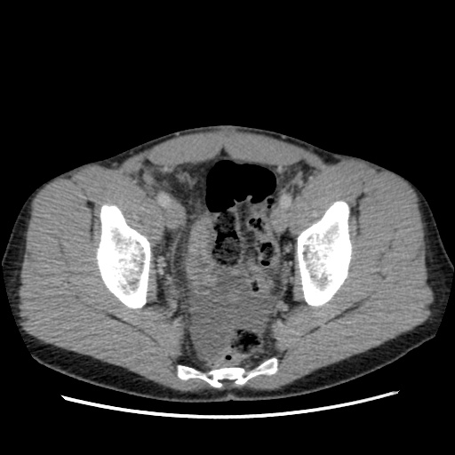 File:Appendicitis complicated by post-operative collection (Radiopaedia 35595-37114 A 76).jpg