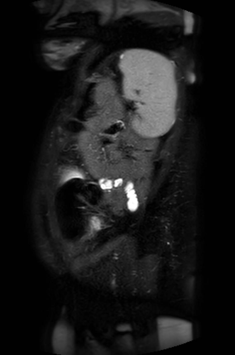 Appendicitis in gravida (MRI) (Radiopaedia 89433-106395 Sagittal T2 SPAIR 10).jpg