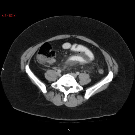 File:Appendicitis with microperforation- promontoric type (Radiopaedia 27268-27442 C 50).jpg